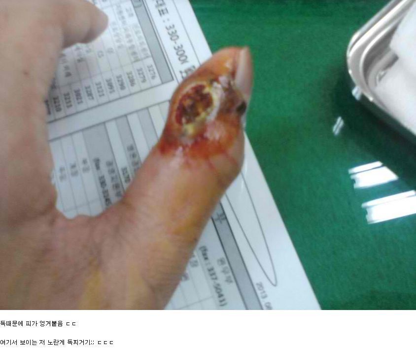 뱀에 물리면 빨리 병원 가야하는 이유 | 인스티즈