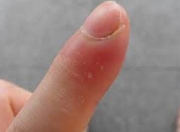 손톱 옆 거스러미 함부로 뜯으면 안되는 이유... | 인스티즈