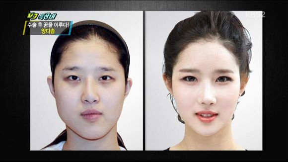 성형수술 성공한 케이스.jpg | 인스티즈