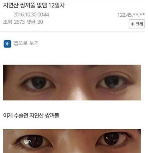 남자 쌍꺼풀 제거 수술 | 인스티즈
