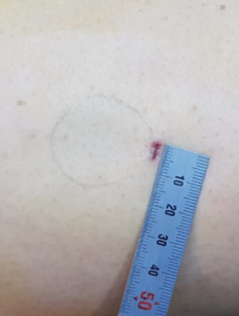 한예슬 지방종 수술사례들 (혐오주의) | 인스티즈