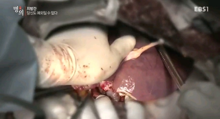 말기 간경변 환자의 간.jpg (사진주의) | 인스티즈